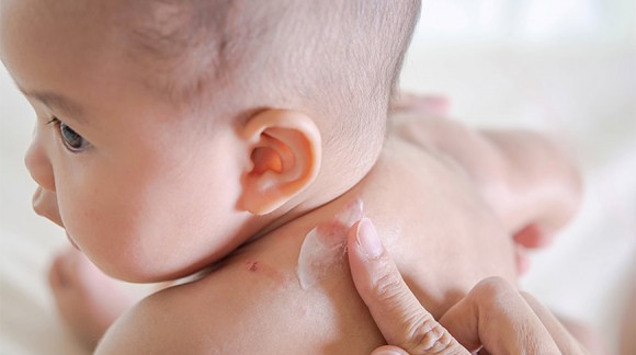 Bebeklerde nikel alerjisi nedir?